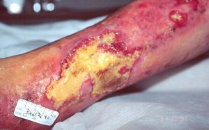 Ulceras de Perna